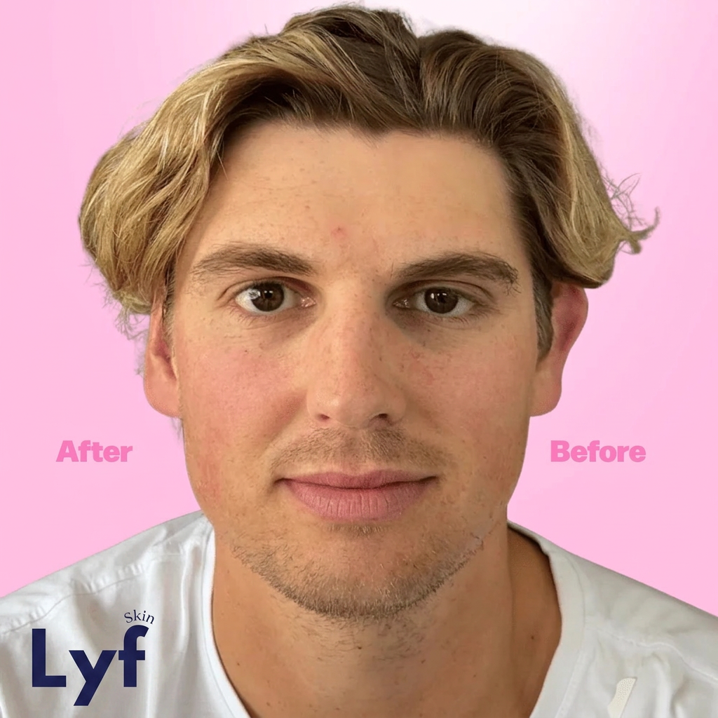 Lyf Ears