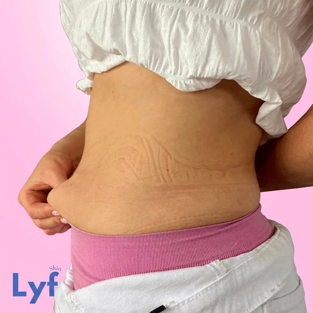Lyf Tummy