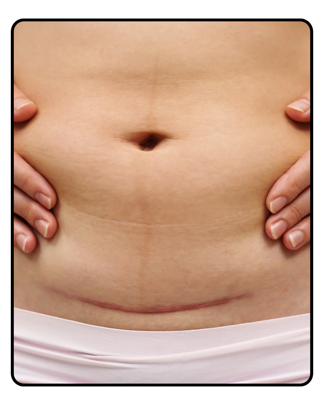 Lyf Tummy